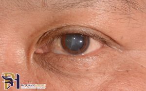 عوارض-جراحی-کاتاراکت