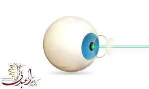 لیزیک یا لازک؛ کدام مناسب تر است؟