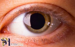 اتساع یا گشادی مردمک چشم چیست و چگونه ایجاد می شود؟