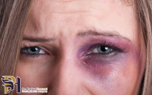 علائم و تشخیص شکستگی کاسه چشم چیست؟