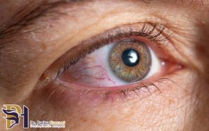 آنچه باید در مورد آلرژی چشم بدانید