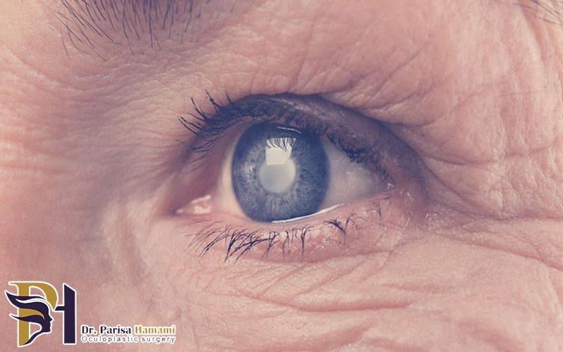 چرا چشم آب سیاه می آورد؟