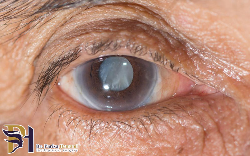 چرا چشم آب سیاه می آورد؟