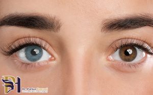 آیا تغییر رنگ چشم ممکن است