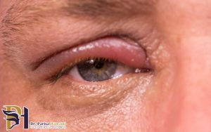 ورم چشم چیست