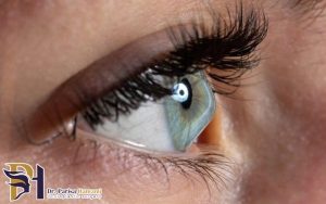 قوز قرنیه چیست