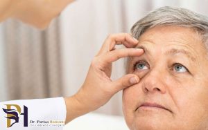 بیرون زدگی چشم از حدقه