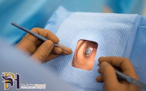 جراحی آب مروارید به روش فیکو