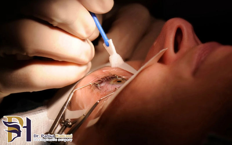 حذف عینک با فمتولیزیک