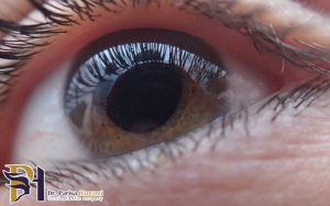 نقش ژنتیک در بروز گلوکوم