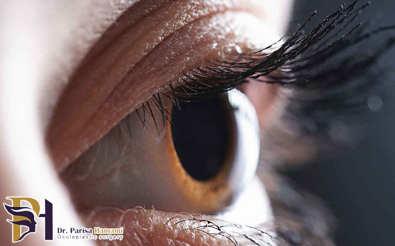 آیا چشم بعد از عمل لیزیک ضعیف می شود