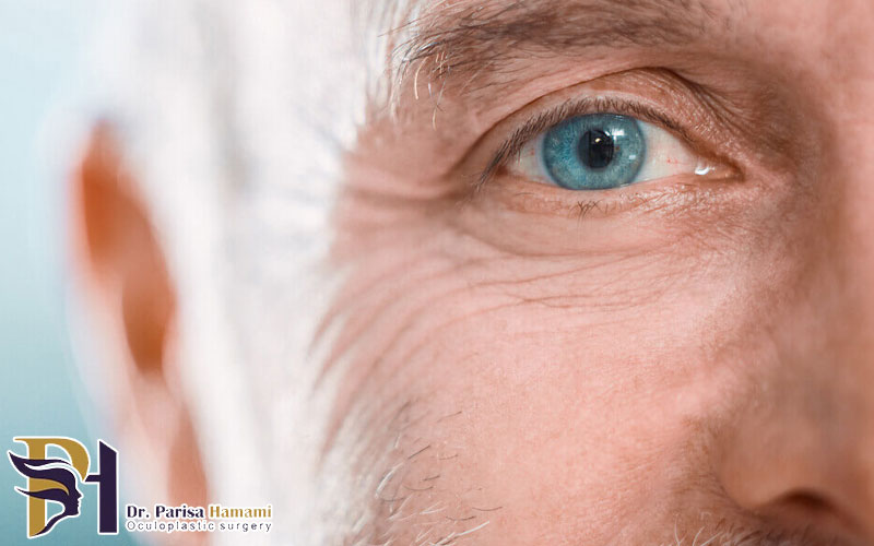 آیا چشم بعد از عمل لیزیک ضعیف می شود