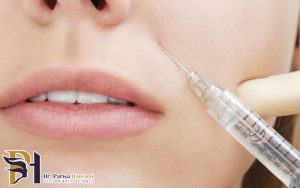 تزریق بوتاکس برای رفع چین و چروک دور لب