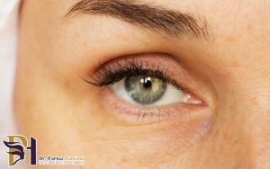 تزریق بوتاکس برای جلوگیری از خطوط اطراف چشم