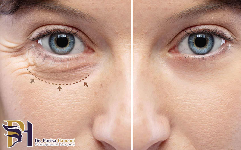 بهترین جراح بلفاروپلاستی