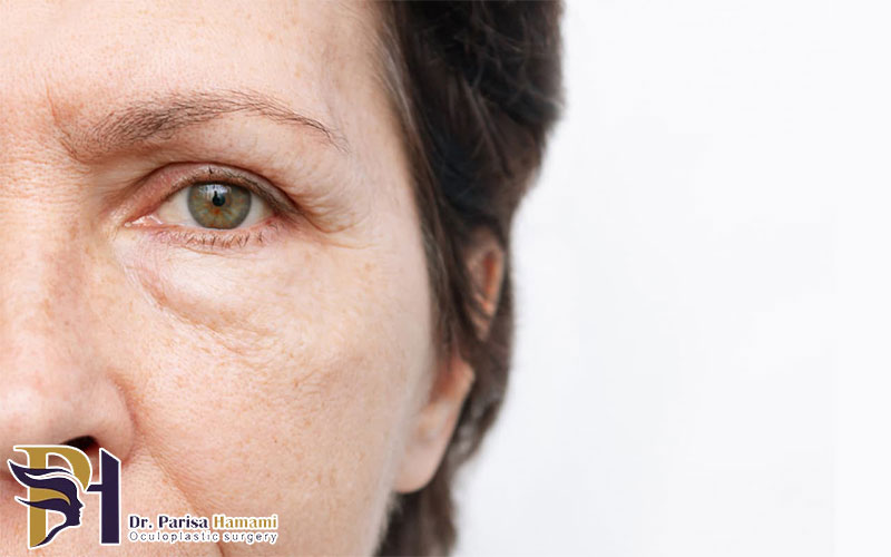 بهترین جراح بلفاروپلاستی