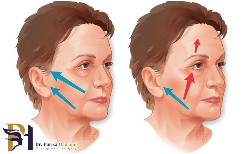 بهترین جراح لیفت صورت