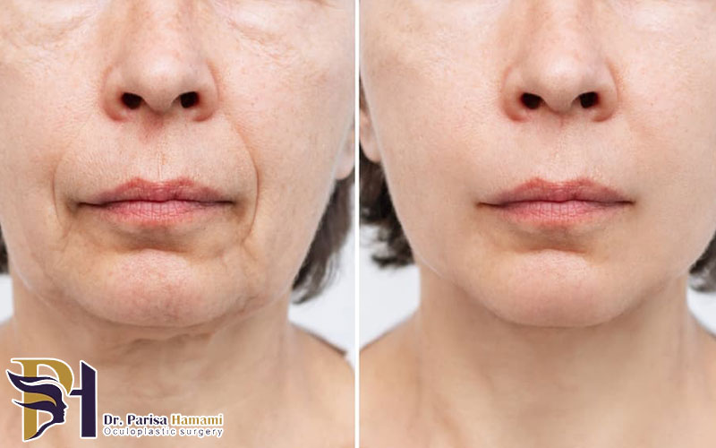 بهترین جراح لیفت صورت