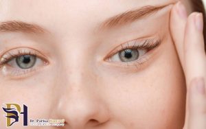 تفاوت بوتاکس چشم گربه ای و لیفت با نخ