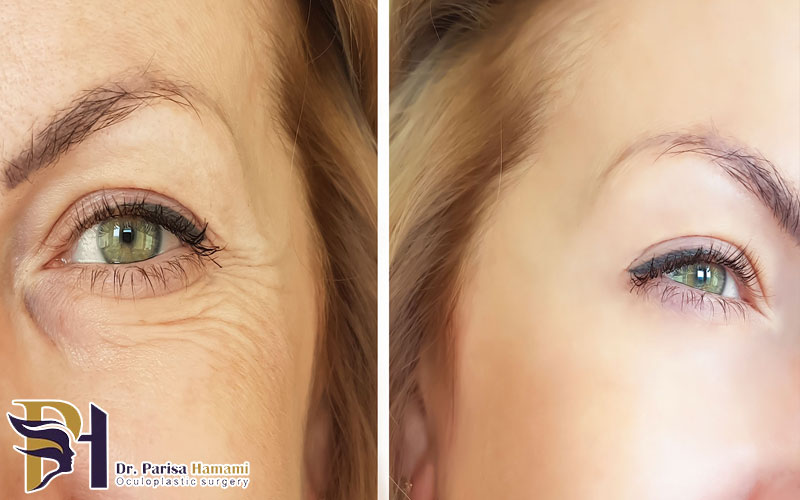 همه چیز درباره اکولوپلاستی