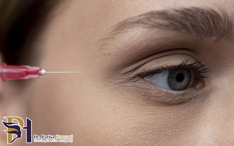 بوتاکس دور چشم در سنین پایین