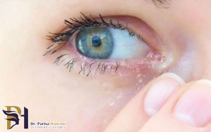 جراحی انسداد مجرای اشک بدون بخیه