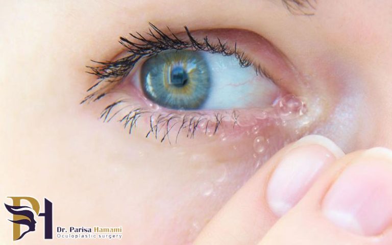 جراحی انسداد مجرای اشک بدون بخیه