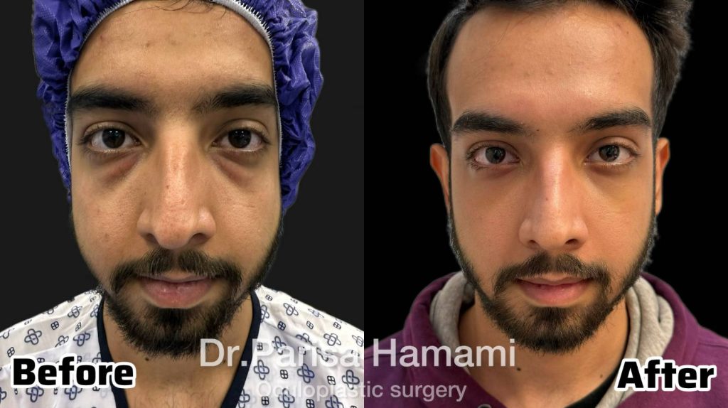 عکس نمونه کار بلفاروپلاستی پلک پایین