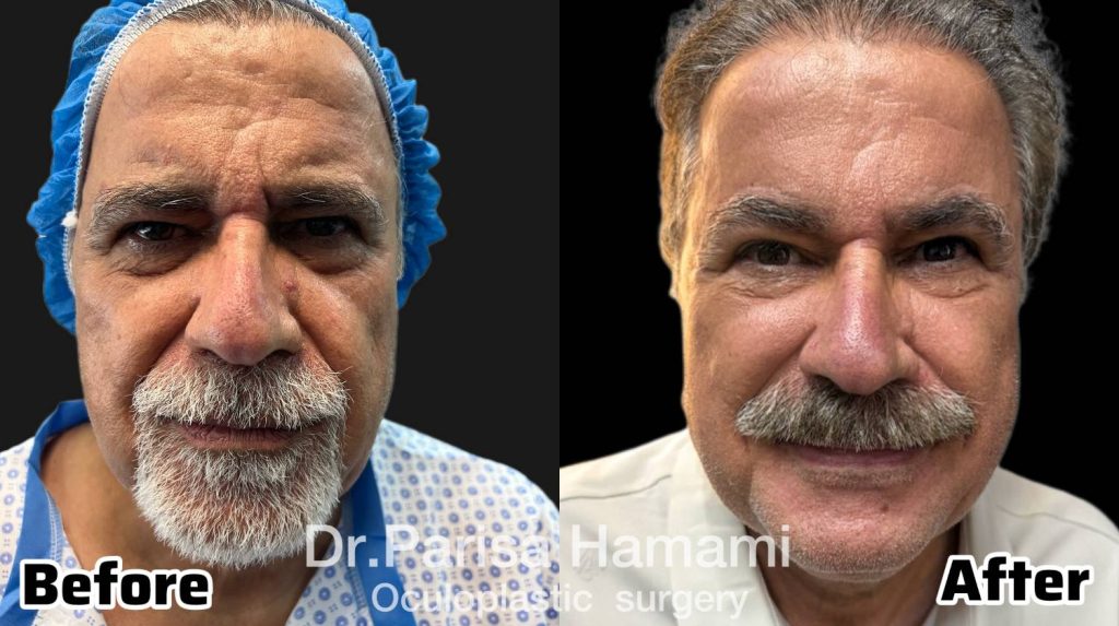 عکس نمونه کار لیفت دایرکت ابرو
