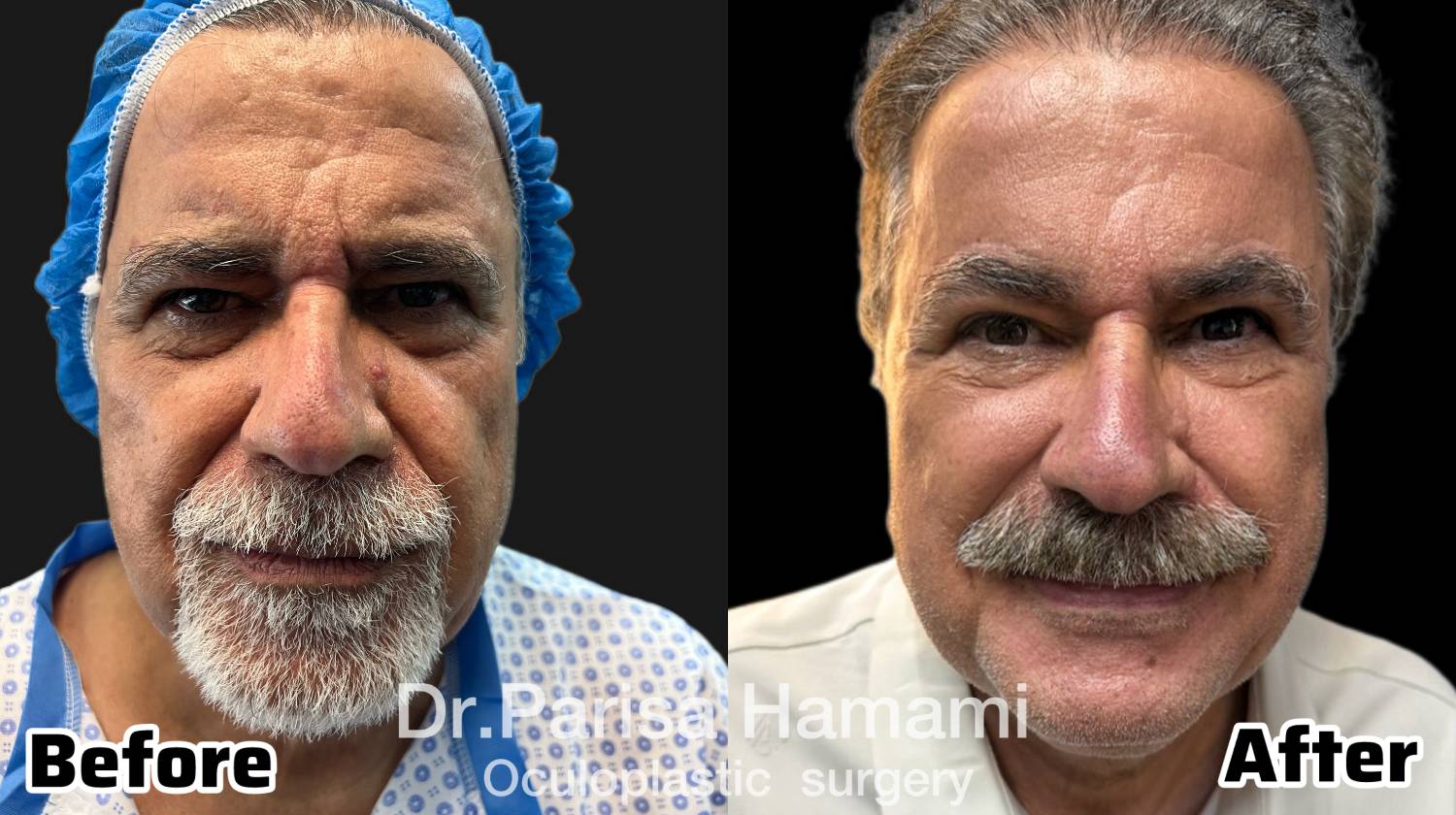 عکس نمونه کار لیفت دایرکت ابرو