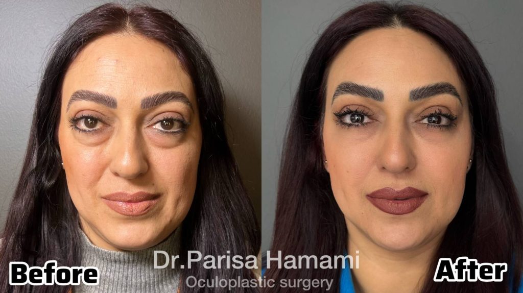 عکس نمونه کار اصلاح بیرون زدگی حدقه