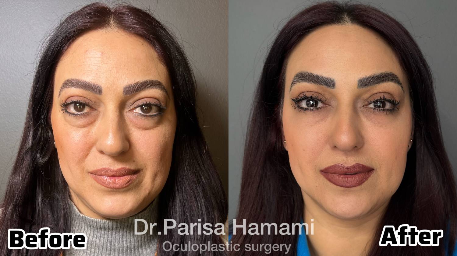 عکس نمونه کار اصلاح بیرون زدگی حدقه