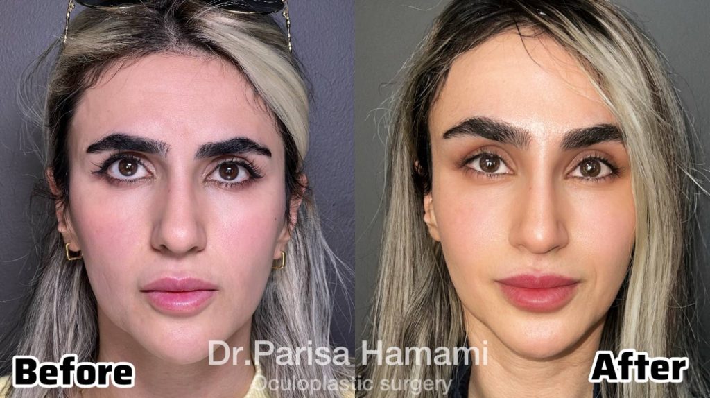 عکس نمونه کار لیفت آندوسکوپیک پیشانی