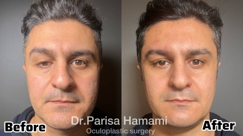 عکس نمونه کار پتوز و افتادگی پلک