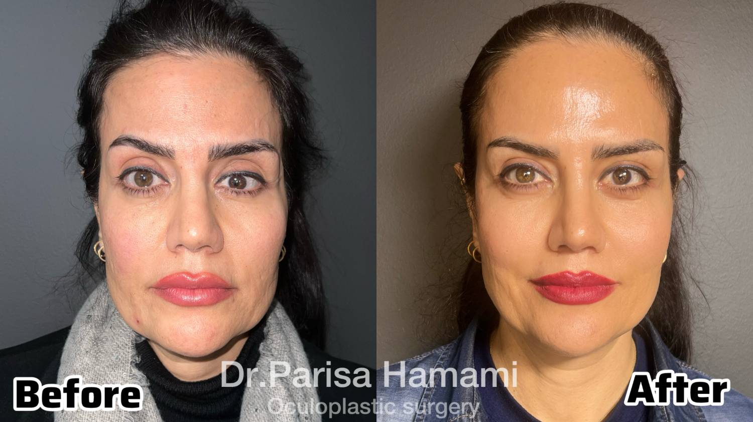 عکس نمونه کار کارگذاری پروتز حدقه