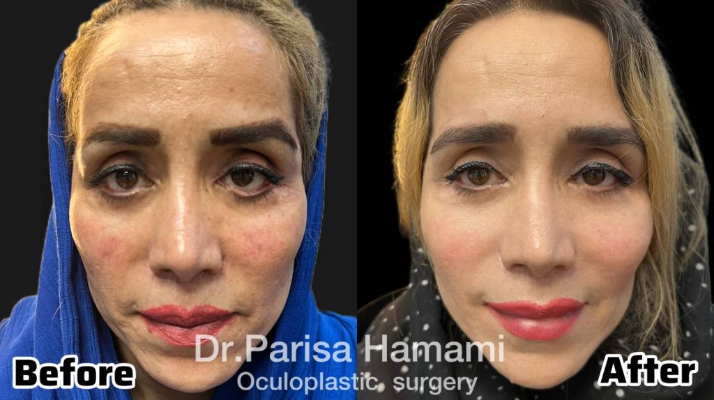 عکس نمونه کار ترمیم پلک