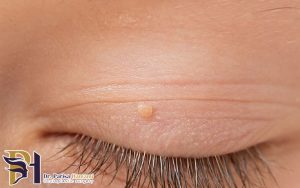 زائده گوشتی روی پلک چیست